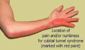 Ulnar nerve entrapment, also known as cubital tunnel syndrome, can